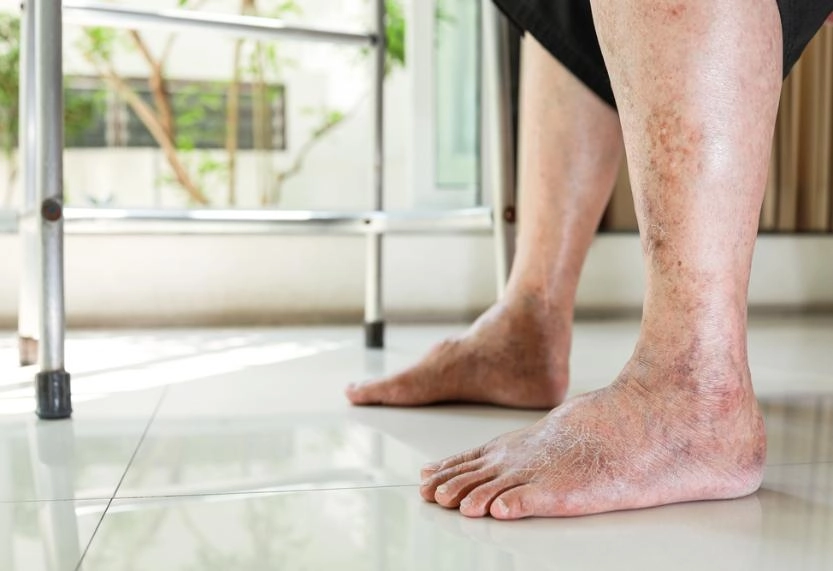 Diabeteses neuropathia