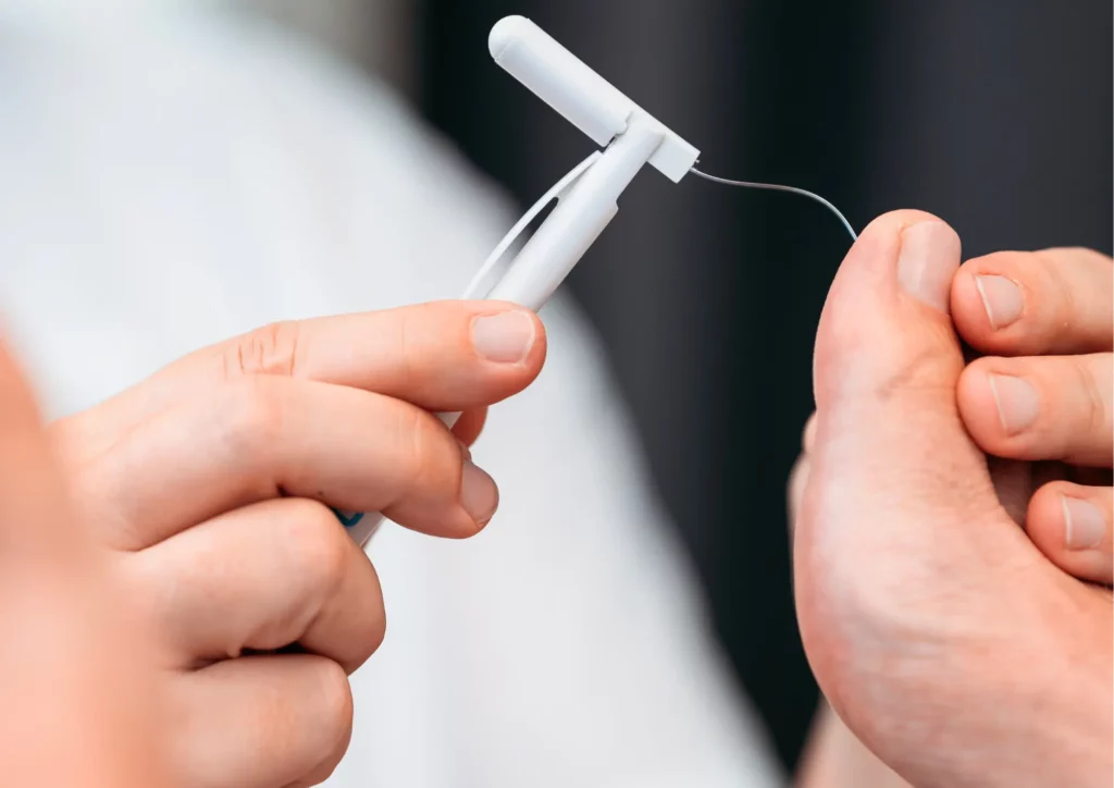 Monofilament_vizsgalat