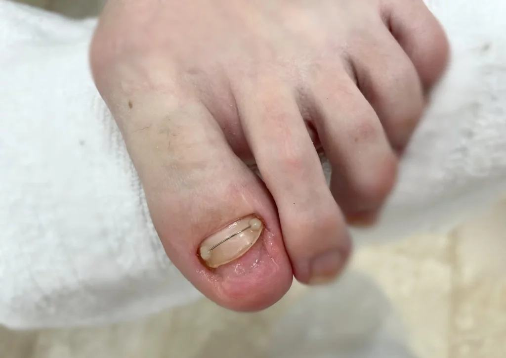 Fémszálas körömszabályozás