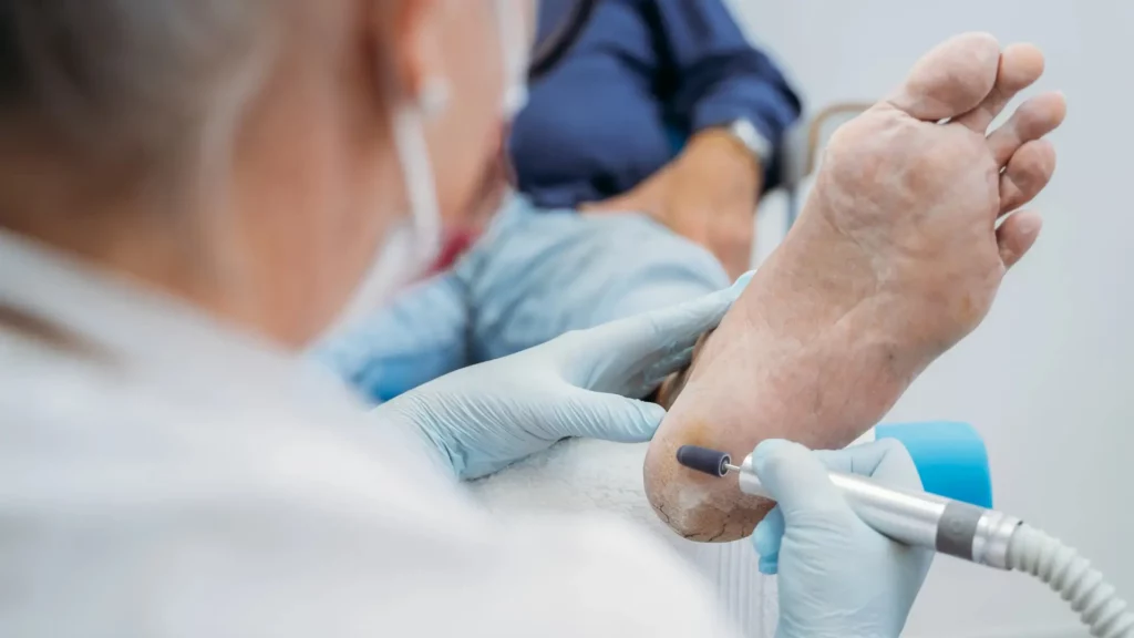 Diabéteszes lábkezelés