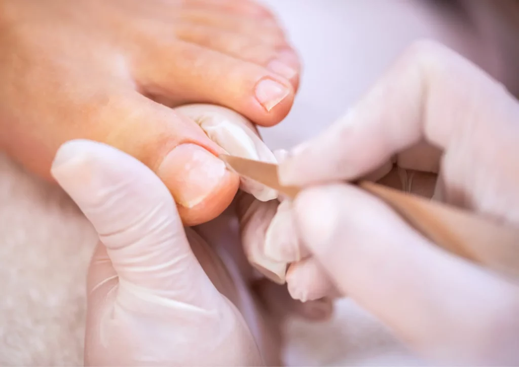 Körömszabályozás