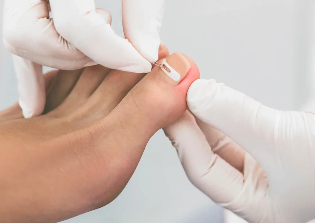 Ragasztott lapka Körömszabályozás